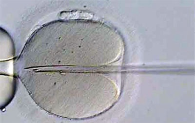 أطفال الأنابيب والحقن المجهري أمل جديد للحد من الأمراض الوراثية