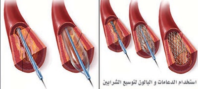 انسداد الشريان التاجي من أمراض القلب الشائعة والمنتشرة