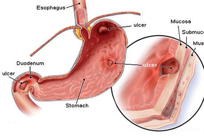 قرحة المعدة من الأمراض السائدة في المجتمع .. ومضاعفاتها خطيرة