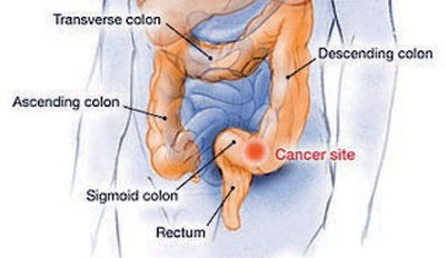 كيف يحدث سرطان القولون؟
