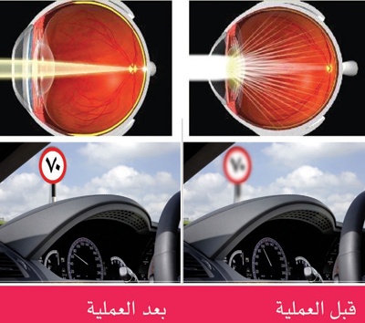 عتامة العدسة.. الأسباب وطرق الوقاية والعلاج