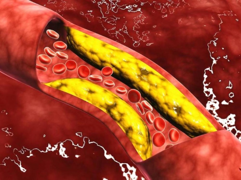 خبراء يكتشفون علاجا لخفض الكوليسترول مرة واحدة