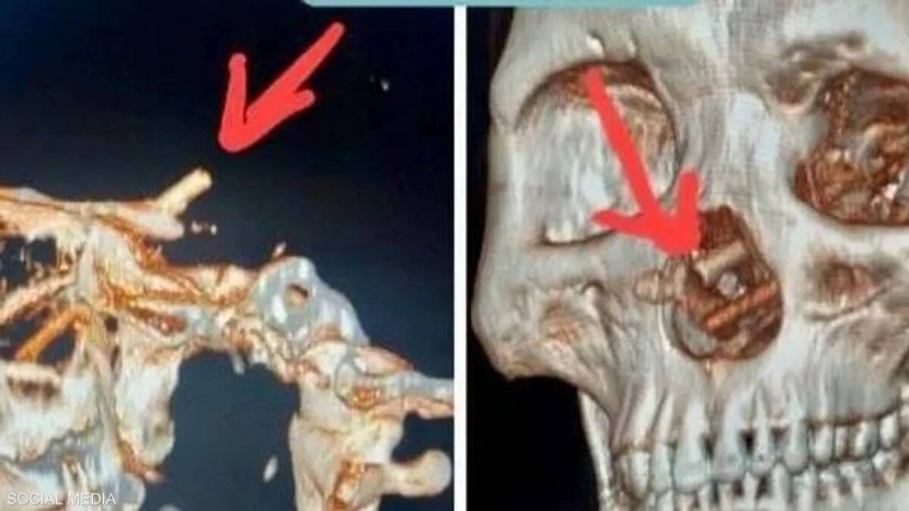 عانى صداعا وفقدان بصر .. رجل يكتشف «مفاجأة» داخل جمجمته